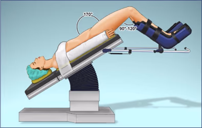 Figure 2: low lithotomy with a thigh-trunk angle of 170° and with the knees above the abdominal plane 